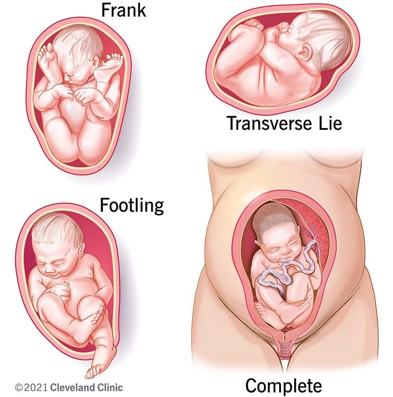 What are the types of breech positions a baby can be in?